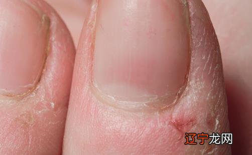 冬天手上长倒刺是因为缺乏维生素