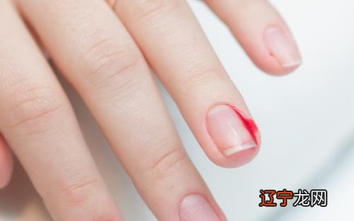 冬天手上长倒刺是因为缺乏维生素