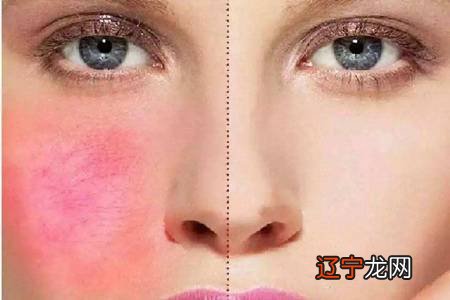 脸过敏发红痒怎么办,春季防过敏教你六个方法