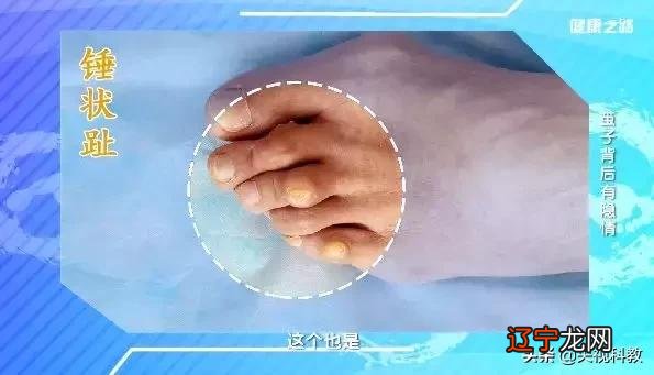 脚型矫正器-脚形