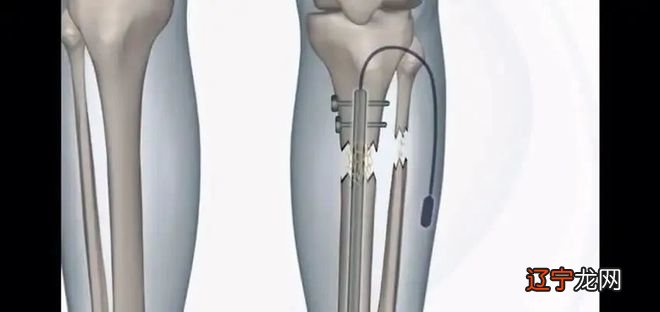 邪术or神之手：硅谷男精英的“断骨贷”，到底有多可怕？